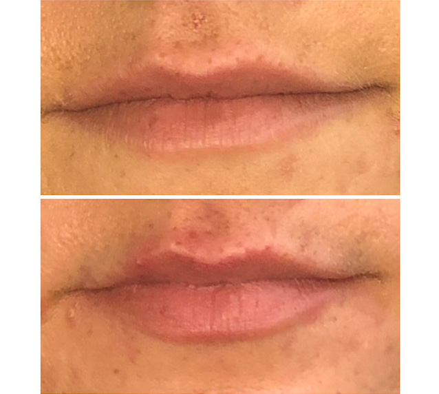 2 Treatment Clearlift Before and After
