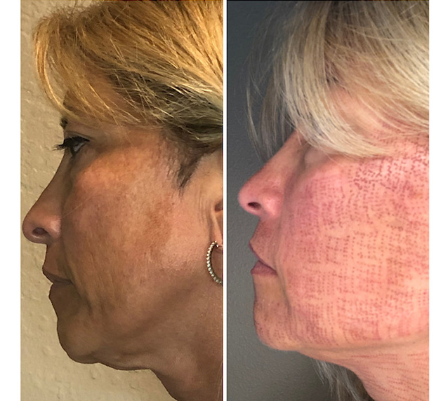 3 Treatments on Clearlift, 1 IPL, Erbium Day 2 Before and After