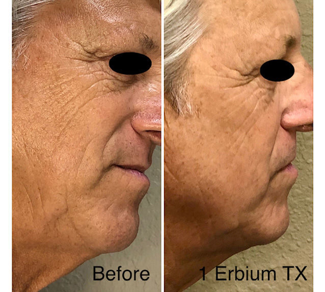 1 Treatment Erbium Before and After